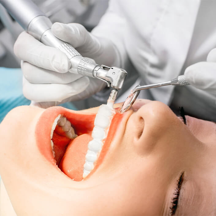 woman with flouride treatment applied to her teeth