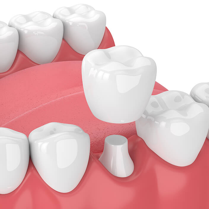 illustration of a dental crown