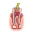 Technical illustration of a root canal.