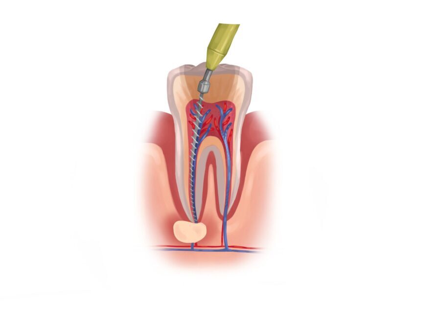 Technical illustration of a root canal.