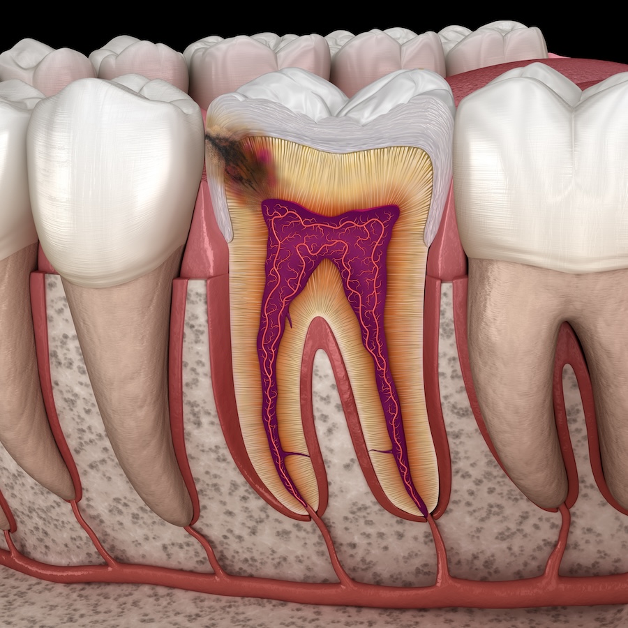 cavity treatment, dental care, dental check-up, Southern Dental Munford, Munford TN, cavity prevention, dental health, tooth decay