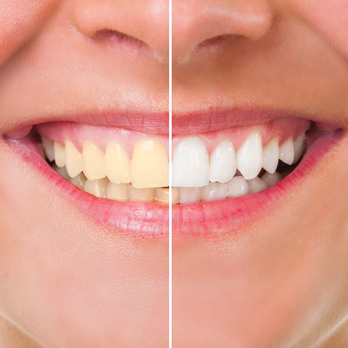 before and after whitening