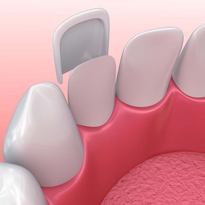 illustration of veneers