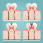 stages of cavity formation