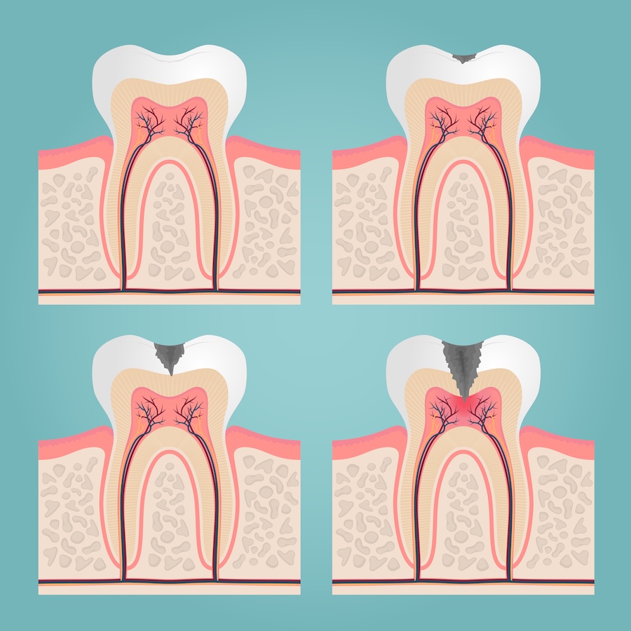 stages of cavity formation