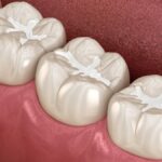 dental sealants