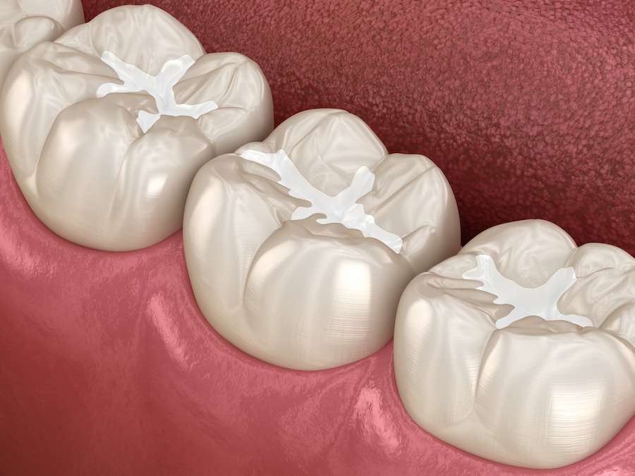 dental sealants
