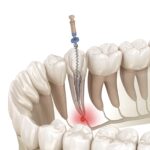 root canal therapy after tooth pain