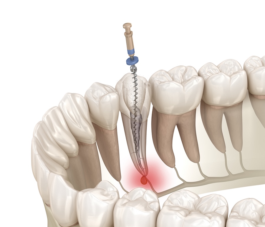 root canal therapy after tooth pain
