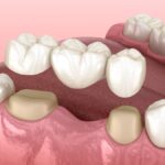 dental bridge and dental crowns