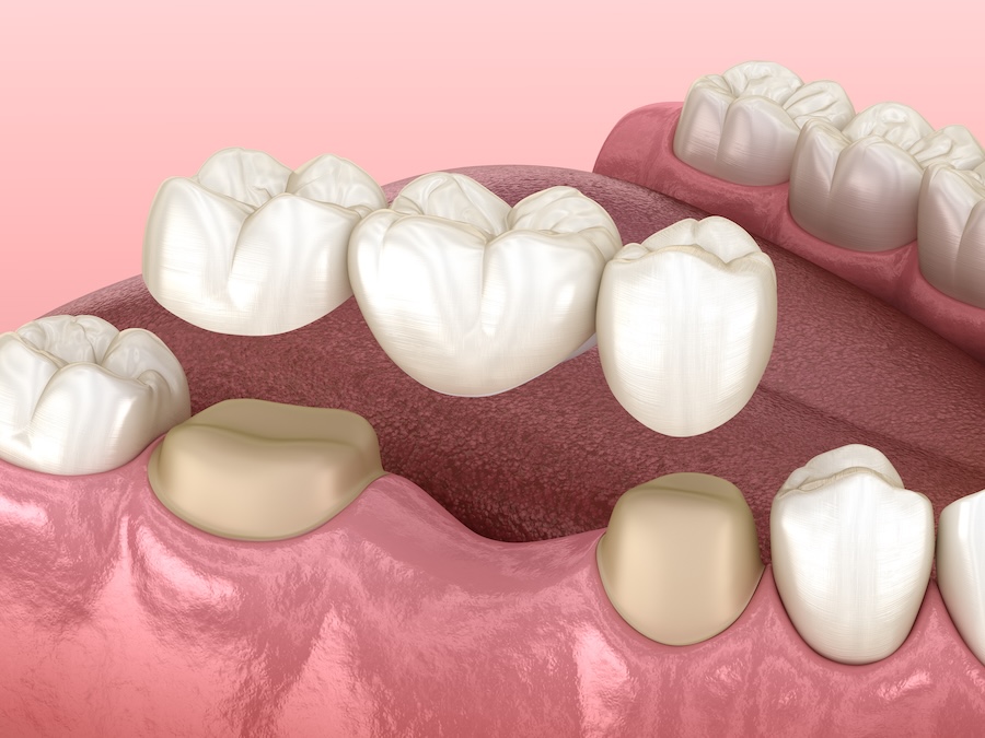 dental bridge and dental crowns